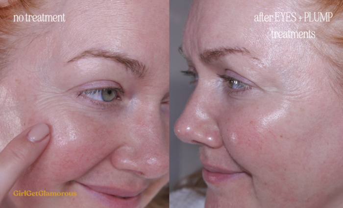 ZIIP Beauty's New Halo Device: All the Info, Review, + Exclusive Back ...